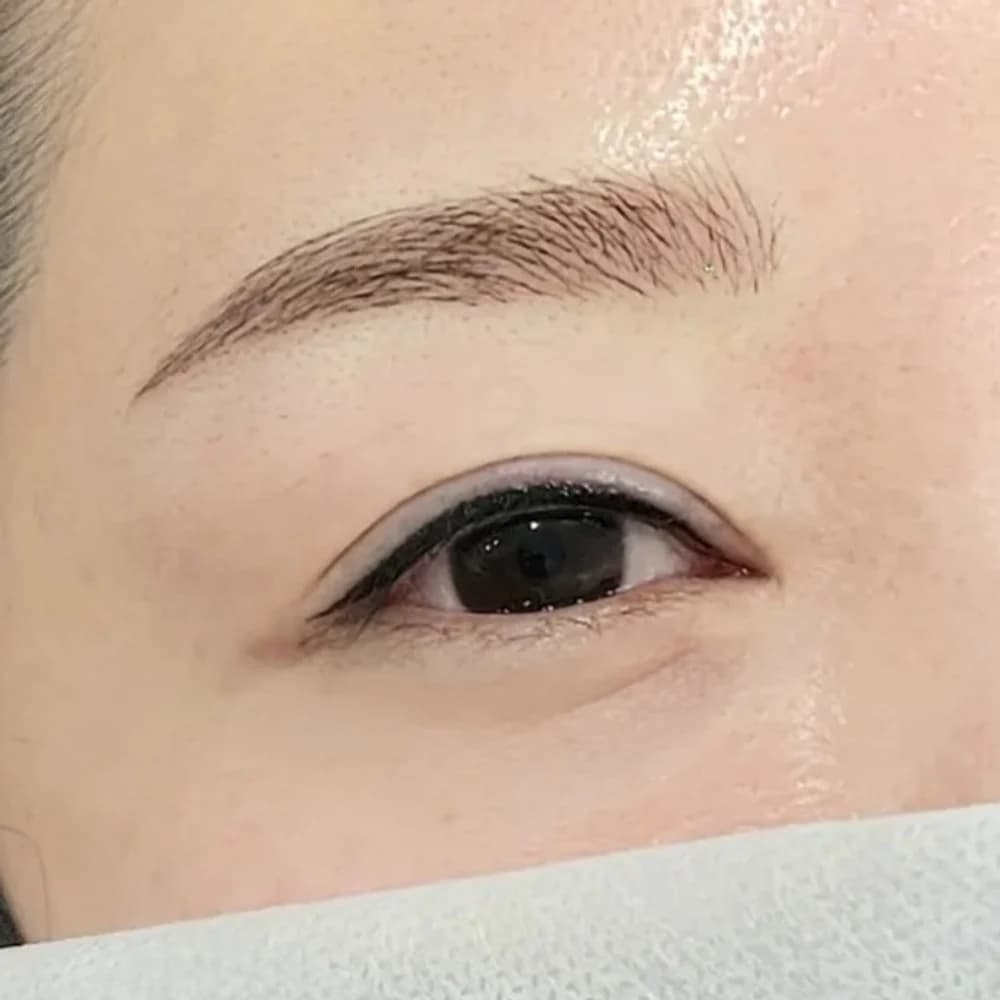 디자인 아이라인 시술 사진