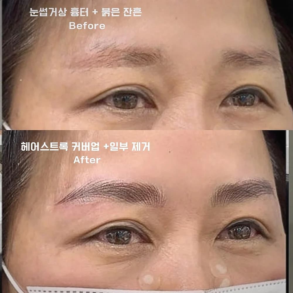 타투리무브 & 커버업 시술 사진