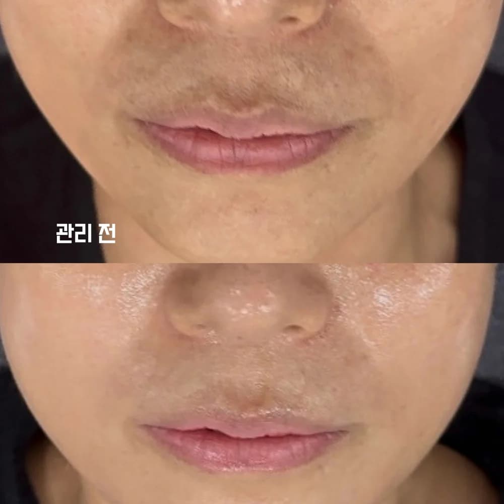 미백 · 리프팅 · 홍조관리 시술 사진