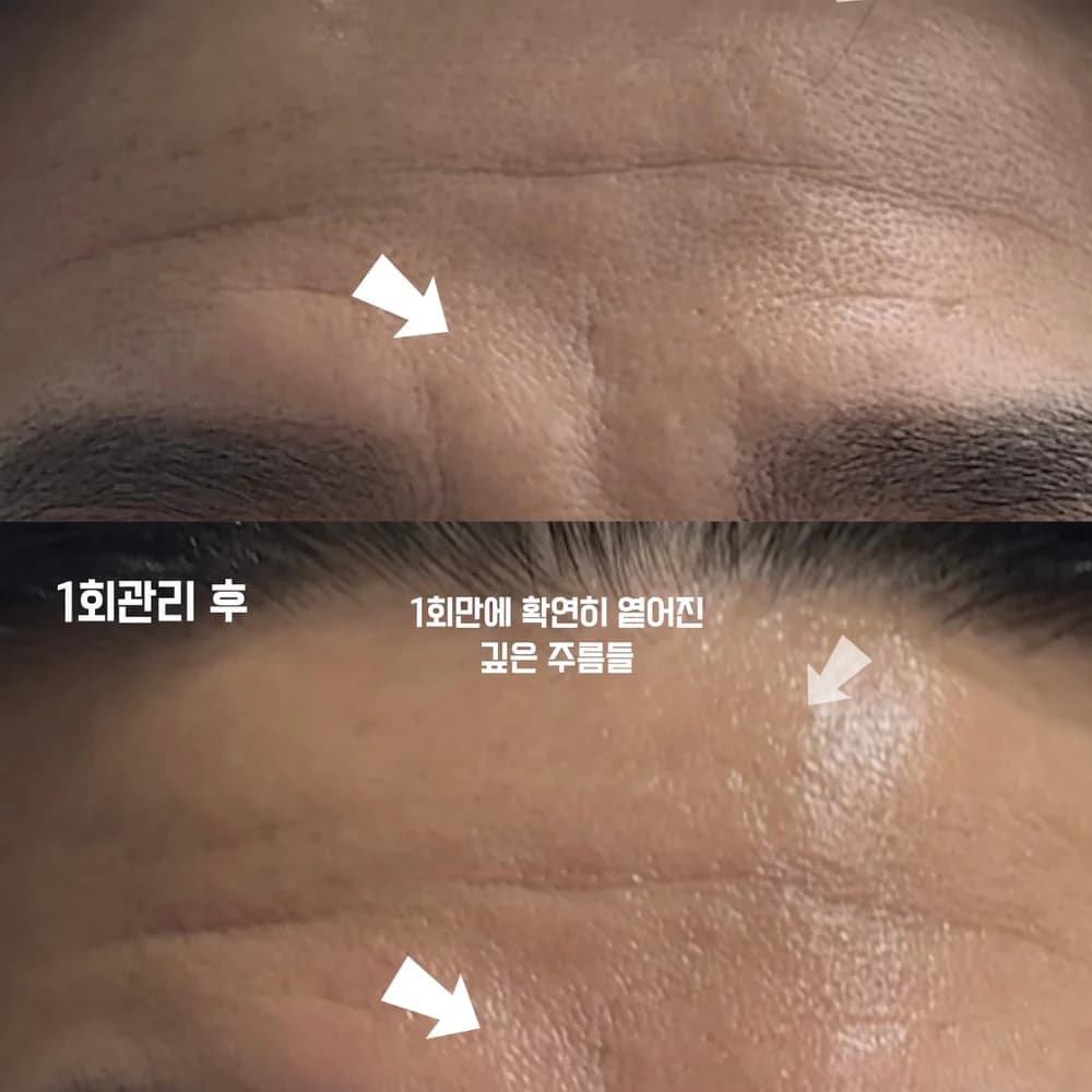 1:1 맞춤 스킨케어 시술 사진