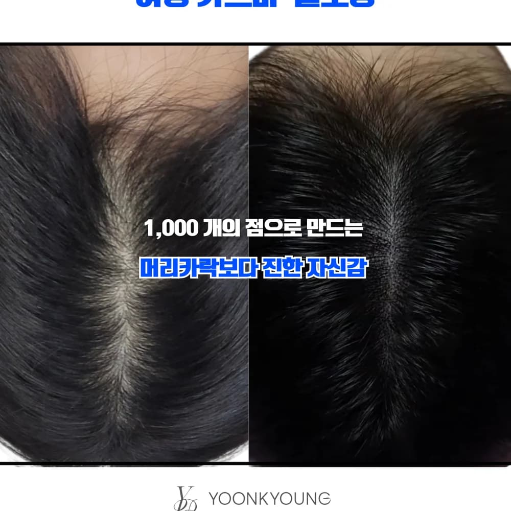 SMP 두피문신 시술 사진