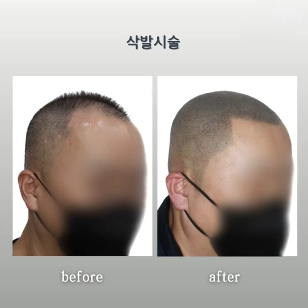 SMP 두피문신 시술 사진